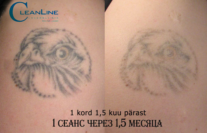cleanline-tatoo-removal