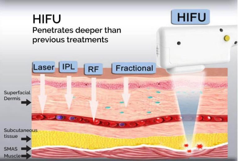 HIFU SMAS-lifting – Cleanline